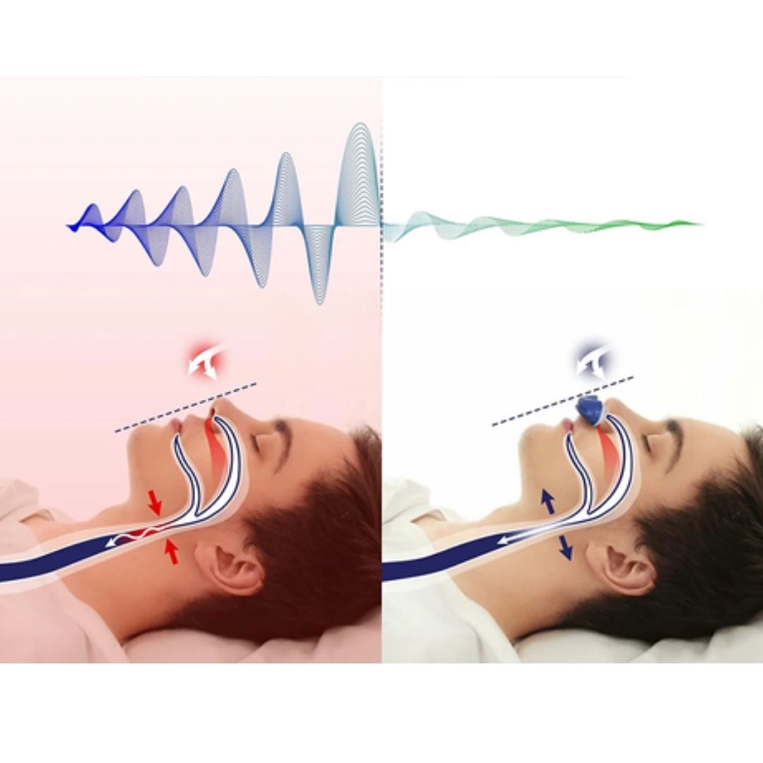 Anti-Schnarchgerät | Drahtloses und maskenfreies Micro-CPAP für besseren Schlaf